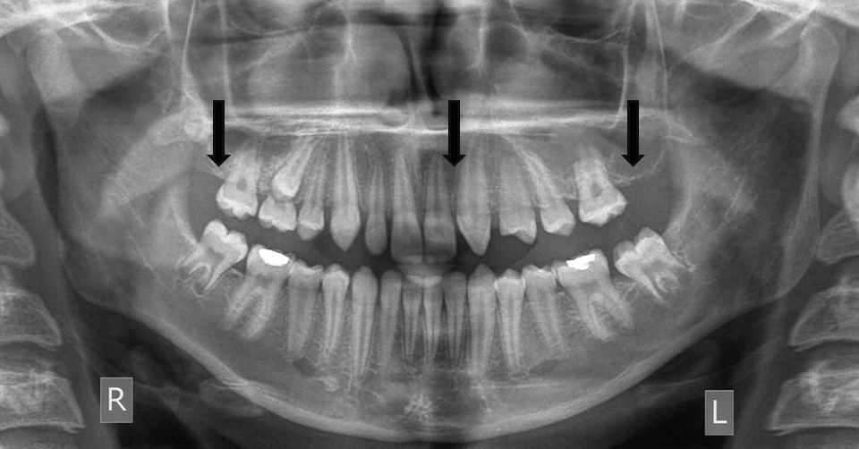 xray agenesis